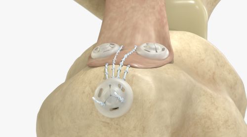 Profesor del Tec de Monterrey crea cinchos quir&uacute;rgicos para reparar tendones y ligamentos